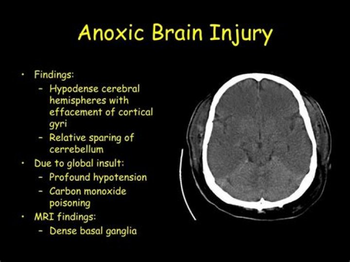 All about anoxic brain injury, the injury suffered by Anne Heche?