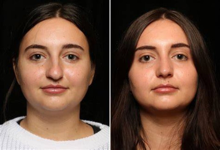 Can I Fix a Deviated Septum Without Surgery? (2022)