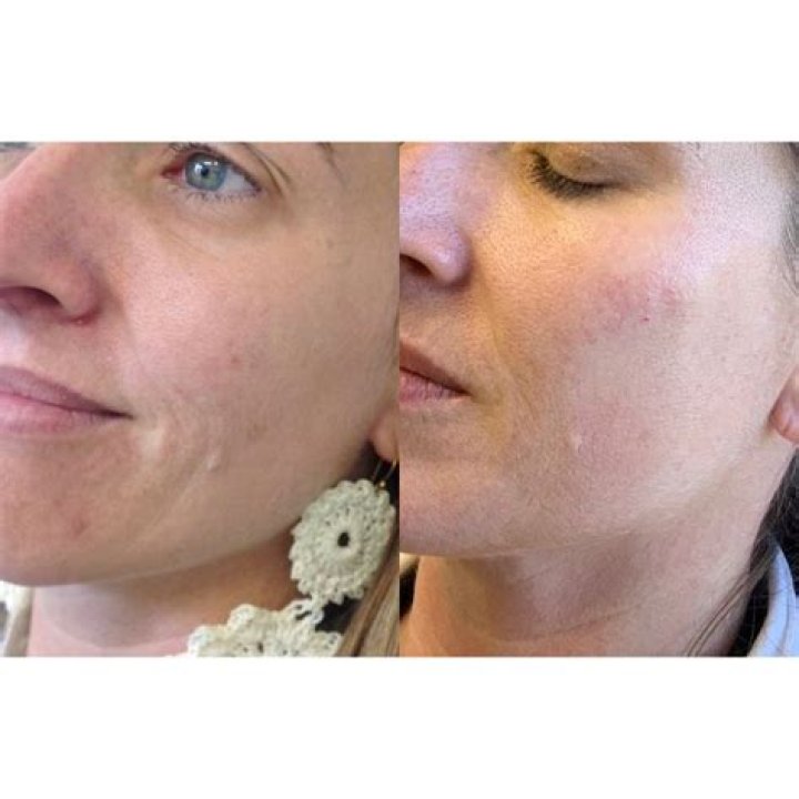 Cheek pop with Volume dermal filler Dermal fillers, Spa day, Beauty