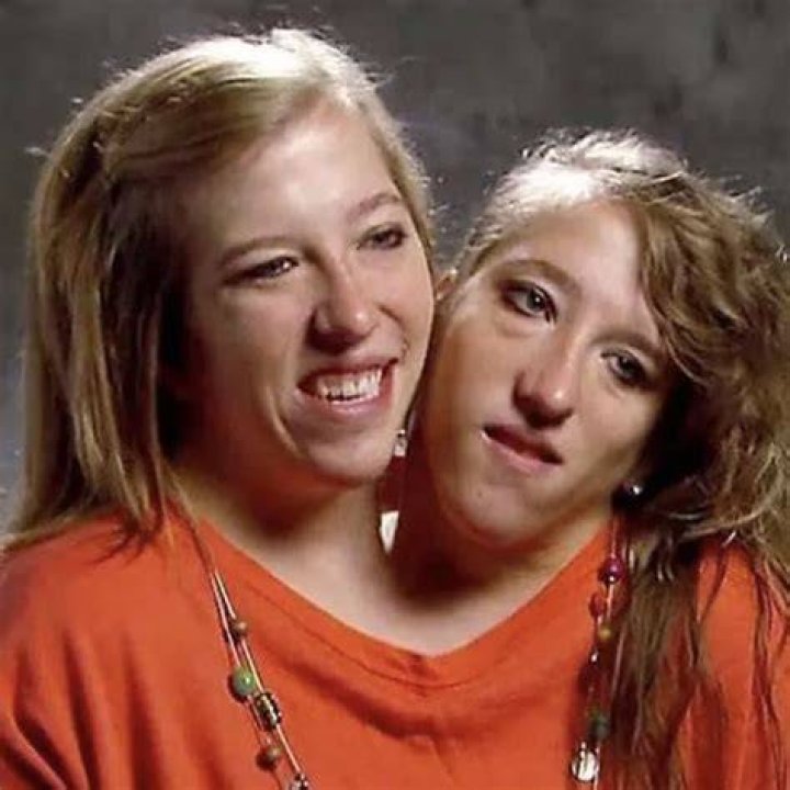 Conjoined Twins Abby & Brittany Hensel Now Their Careers, Health