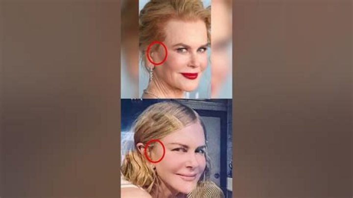 Did Nicole Kidman have a breast augmentation? Lett Center