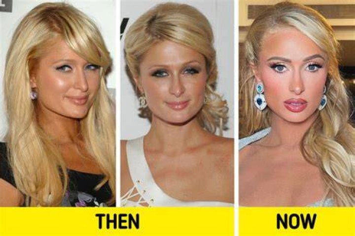 Did Paris Hilton Get Plastic Surgery? The Heiress’ Quotes about Botox