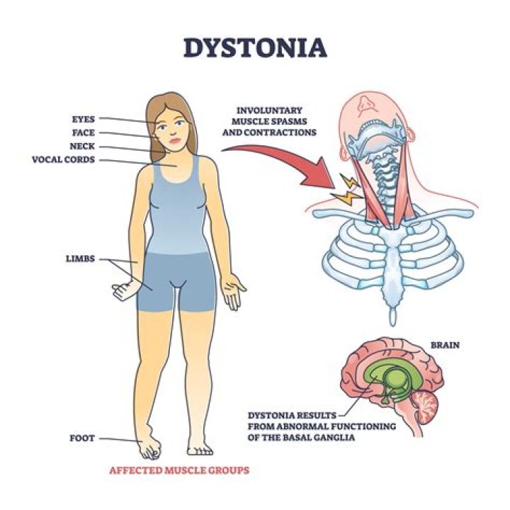 Does Kerry Kennedy Suffer From Spasmodic Dysphonia?