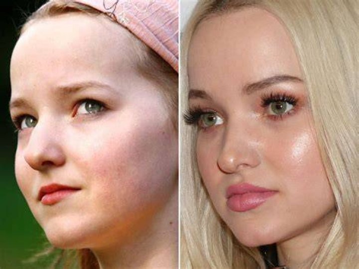 Dove Cameron Before and After From 2008 to 2022 The Skincare Edit