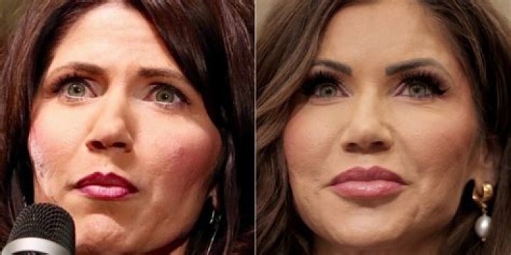 Exploring Kristi Noem: Plastic Surgery Before And After