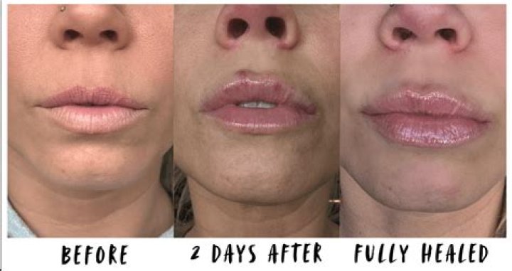 How Long Does Two-Faced Lip Injections Really Last? Find Out Here