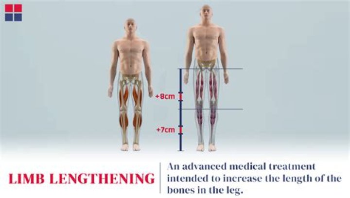 Is limb lengthening safe?