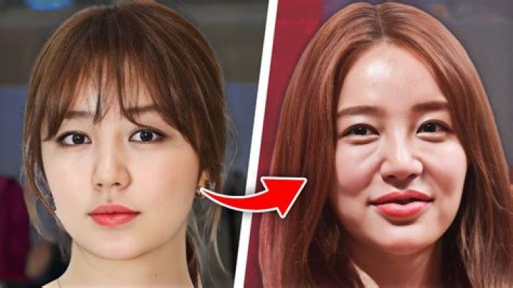 Korean Actor Plastic Surgery Before And After Photos