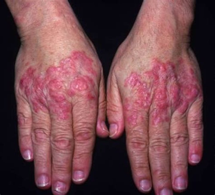 Lupus Systemic Lupus Erythematosus (SLE) Causes, Sign & Symptoms