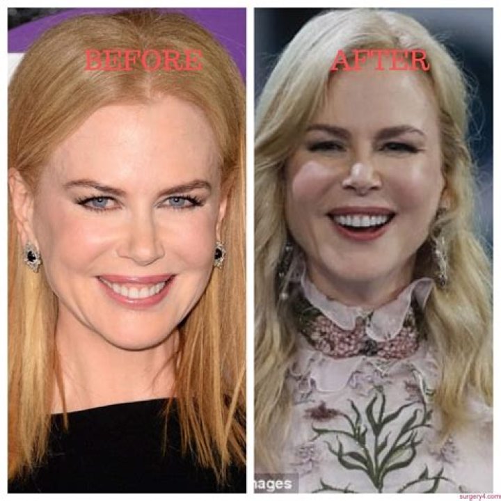 Nicole Kidman and her plastic surgery procedures