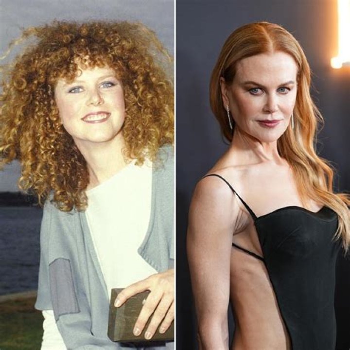 Nicole Kidman before and after plastic surgery (28) Celebrity plastic