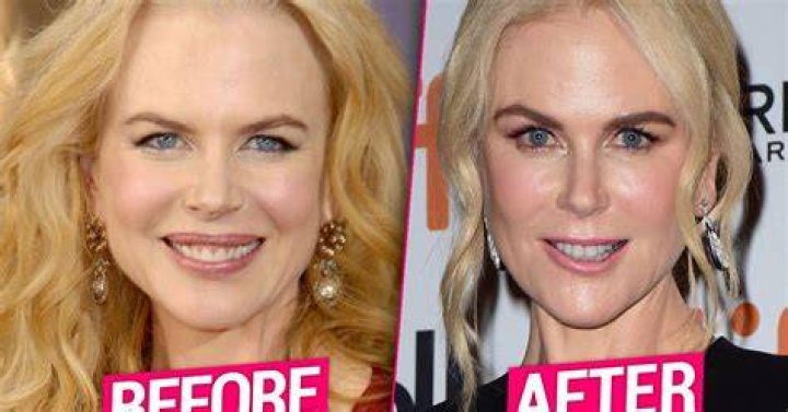 Nicole Kidman Plastic Surgery Facelift, Lip Augmentation, Breast increase