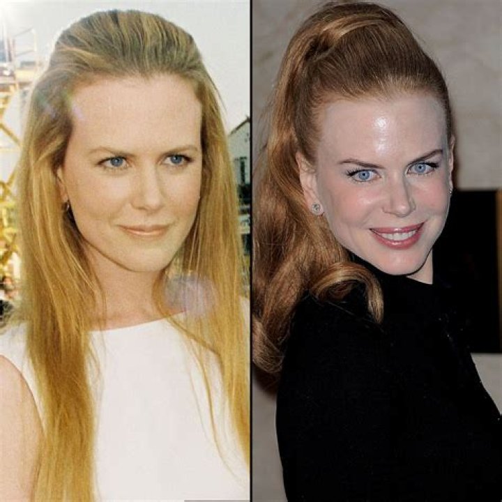 Nicole Kidman's Plastic Surgery What Changes Did She Make? IWMBuzz