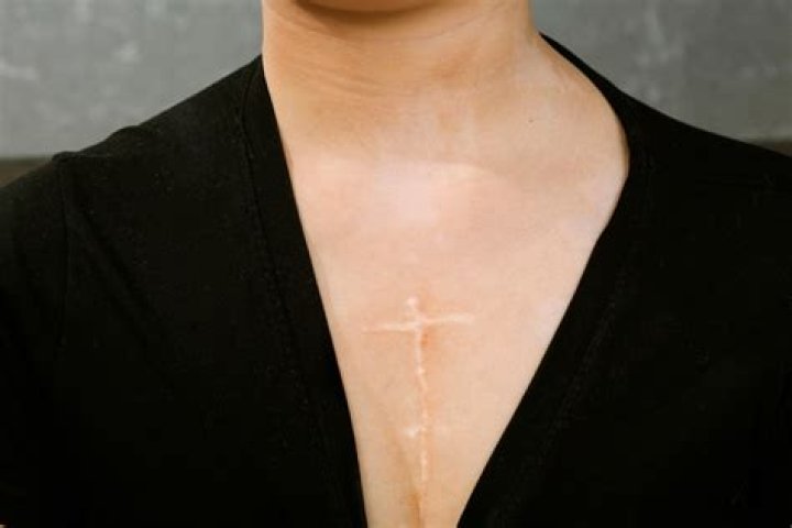 Open Heart Surgery Scar Healing How to care scars Miami, FL
