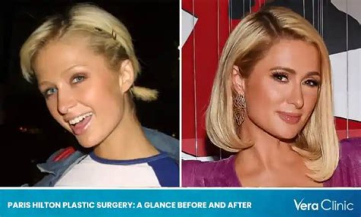 Paris Hilton Plastic Surgery Before and After Pictures 2024