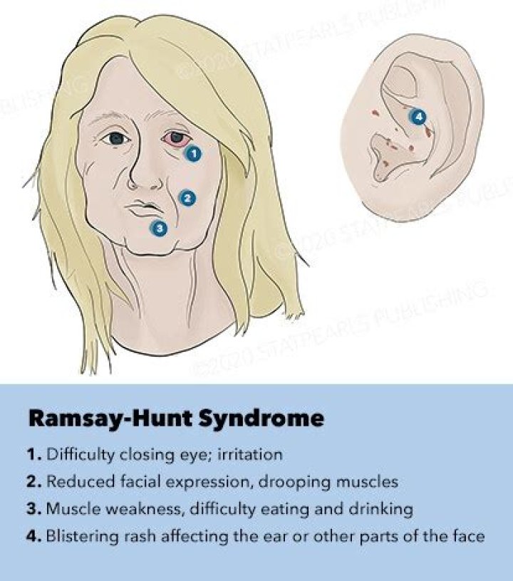 Ramsay Hunt Syndrome Causes, Symptoms, Recovery Time & Treatment