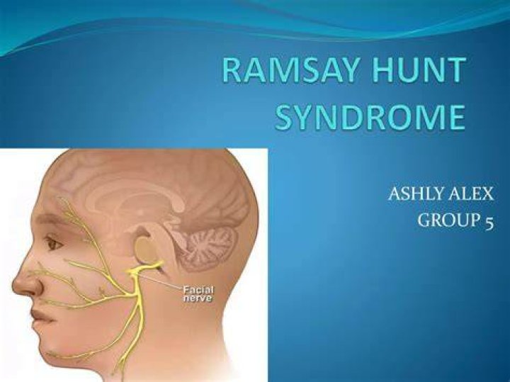 Ramsay Hunt Syndrome What Is It, Causes, Treatment, and More Osmosis