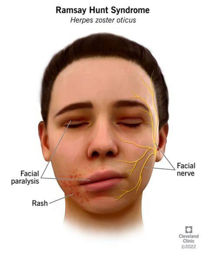 Ramsay Hunt Syndrome