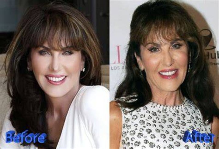 Robin McGraw Before and After Cosmetic Procedures? Verge Campus