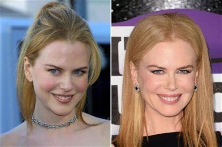 The Truth About Nicole Kidman's Plastic Surgery Journey