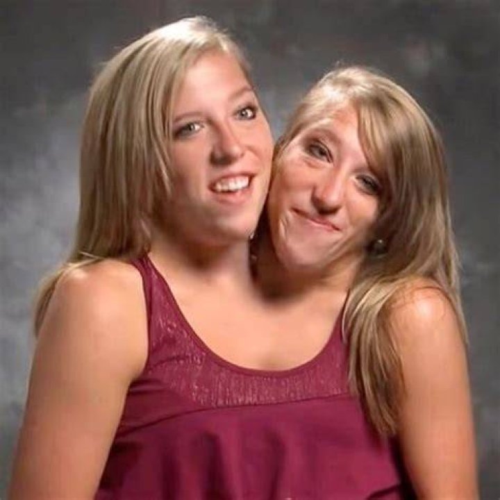 What Conjoined Twins Abby And Brittany Hensel Look Like Now